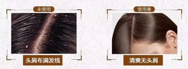 脫發、掉發、頭發稀少？用它洗洗，一次就離不開